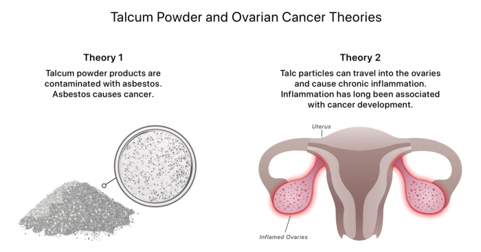 Talcum Powder-Long-Term Use Linked to Both Mesothelioma and Ovarian ...