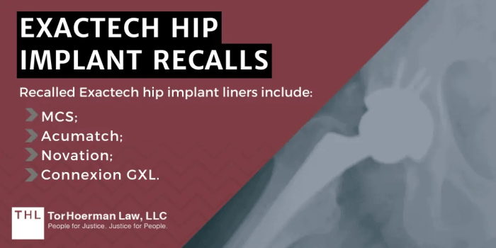 Exactech Lawsuit [2026 Update] | Exactech Recall Lawsuits